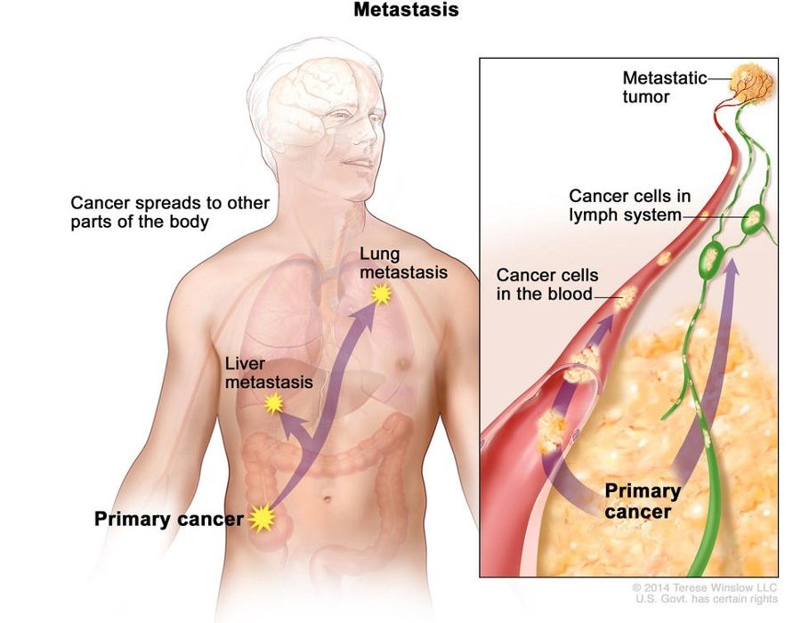 kanser metastazı